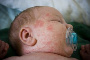 alergie u novorodencov