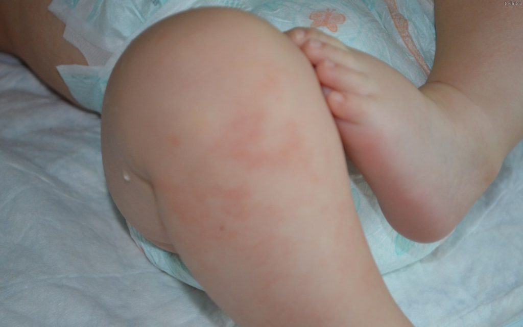 les allergies de l'enfant