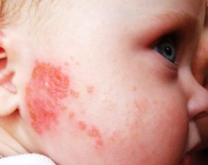 παιδικές αλλεργίες