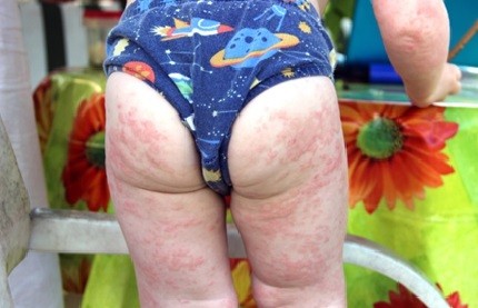 Projev alergií u dětí